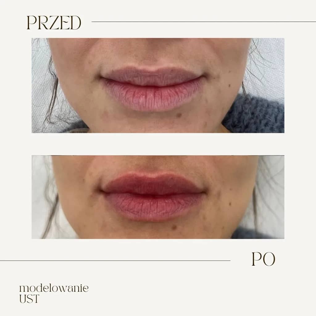 modelowanie-ust-kwasem-hialuronowym-przed-po