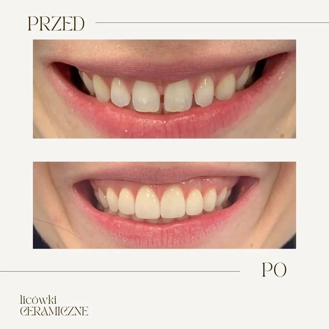 Stomatologia-Estetyczna-licówki-ceramiczne-przed-po