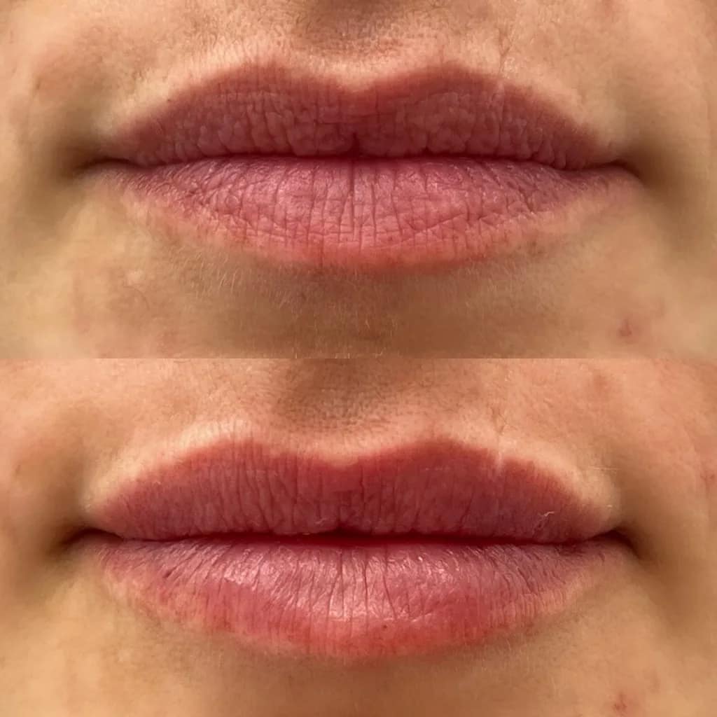 modelowania-ust-kwasem-hialuronowym-przed-po