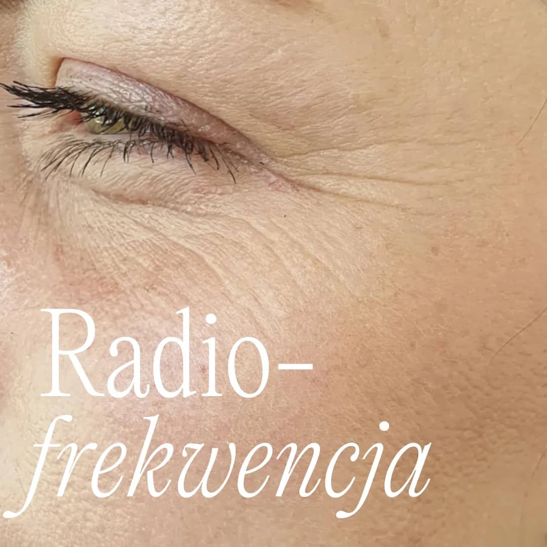 nowoczesny-zabieg-radiofrekwencji-mikroigłowej