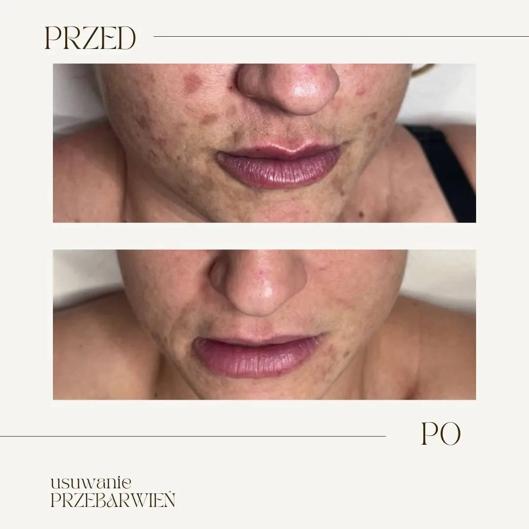 usuwanie-opornych-przebarwień-przed-po-02